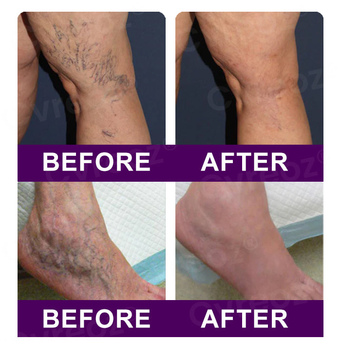 Cvreozยฎ Polidocanol Nano Patches for Varicose Veins (๐๐% ๐๐ฝ๐ฝ ๐๐ก๐๐ฆ ๐๐ก ๐ญ๐ฌ ๐ ๐๐ก๐จ๐ง๐๐ฆ)