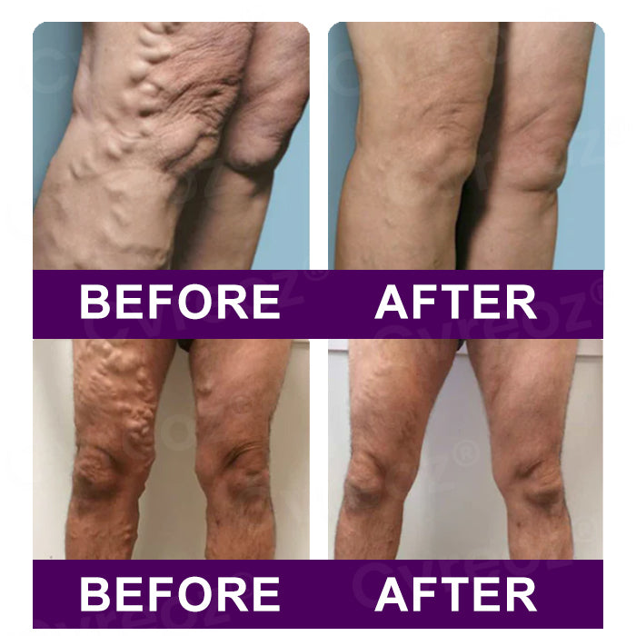 Cvreozยฎ Polidocanol Nano Patches for Varicose Veins (๐๐% ๐๐ฝ๐ฝ ๐๐ก๐๐ฆ ๐๐ก ๐ญ๐ฌ ๐ ๐๐ก๐จ๐ง๐๐ฆ)