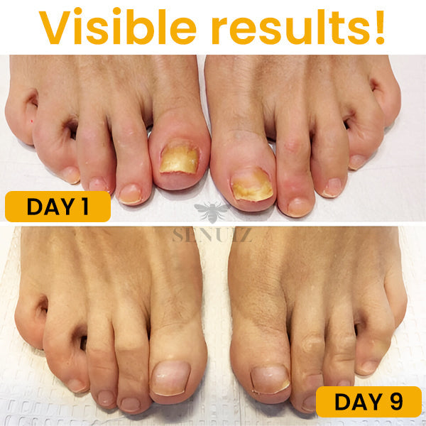 SENUIZ™ Bee Venom Nail Fungus Treatment Soak (10pcs) - (SALE ENDS IN 10 MINUTES)