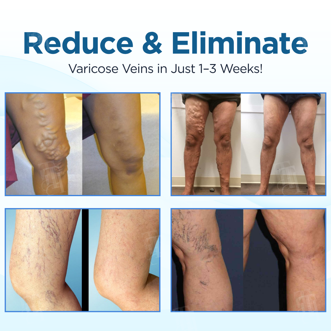 Cvreoz® Herbal Varicose Veins Treatment Spray (𝟟𝟘% 𝕆𝔽𝔽 𝗘𝗡𝗗𝗦 𝗜𝗡 𝟭𝟬 𝗠𝗜𝗡𝗨𝗧𝗘𝗦)