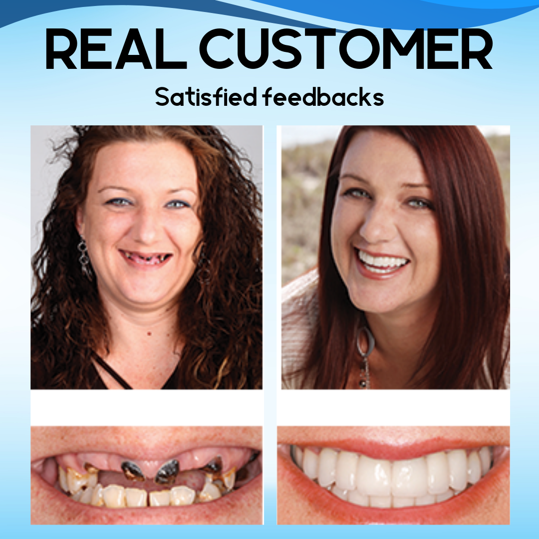 Bikendaยฎ Silicone Snap On Veneers (๐๐% ๐๐ฝ๐ฝ ๐๐ก๐๐ฆ ๐๐ก ๐ญ๐ฌ ๐ ๐๐ก๐จ๐ง๐๐ฆ)