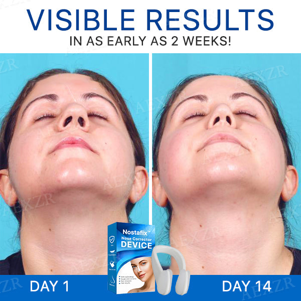 Nostafix™ Nose Corrector Device (SALE ENDS IN 10 MINUTES)