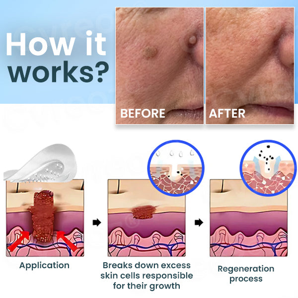 Cvreoz® Nano-Micro Needle Skin Tags Removal Patches (𝟟𝟘% 𝕆𝔽𝔽 𝗘𝗡𝗗𝗦 𝗜𝗡 𝟭𝟬 𝗠𝗜𝗡𝗨𝗧𝗘𝗦)