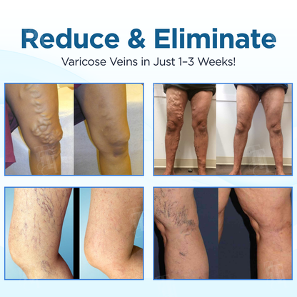 Cvreoz® Herbal Varicose Veins Treatment Spray (𝟟𝟘% 𝕆𝔽𝔽 𝗘𝗡𝗗𝗦 𝗜𝗡 𝟭𝟬 𝗠𝗜𝗡𝗨𝗧𝗘𝗦)