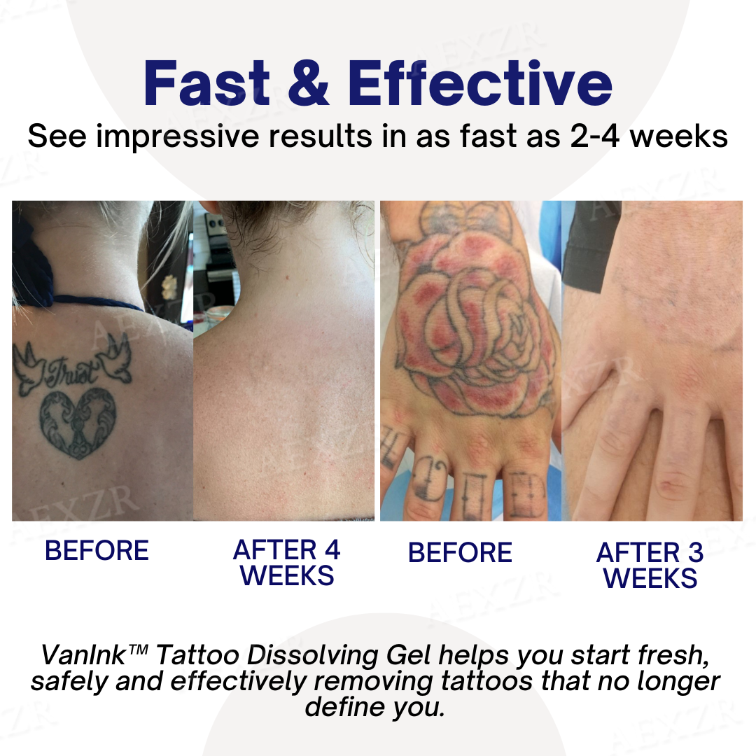 VanInk™ Tattoo Dissolving Gel (SALE ENDS IN 10 MINUTES)