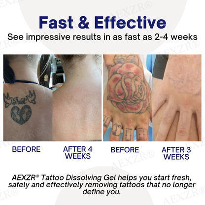 AEXZR® Tattoo Dissolving Gel (𝟟𝟘% 𝕆𝔽𝔽 𝗘𝗡𝗗𝗦 𝗜𝗡 𝟭𝟬 𝗠𝗜𝗡𝗨𝗧𝗘𝗦)