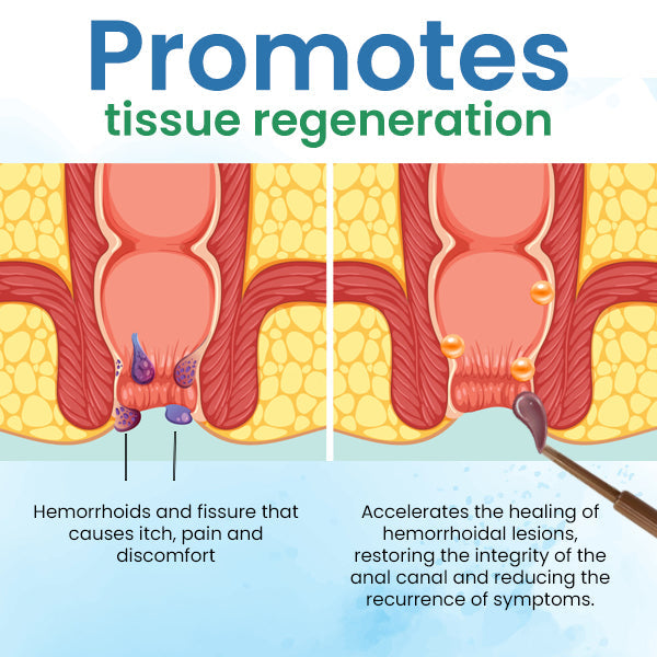 Quezy™ Hemorrhoids Treatment Gel