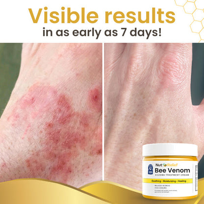 NutRelief™ Bee Venom Eczema Treatment Cream (SALE ENDS IN 10 MINUTES)