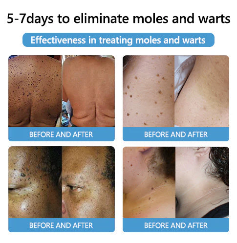 Cvreoz® PRO Bee Venom Mole and Wart Treatment Cream