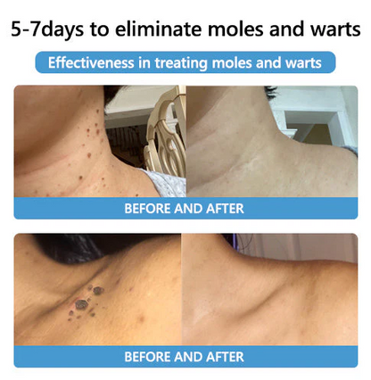 Cvreoz® PRO Bee Venom Mole and Wart Treatment Cream