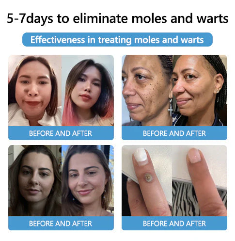 Cvreoz® PRO Bee Venom Mole and Wart Treatment Cream